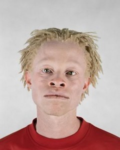 African_albino